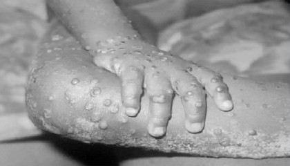 দেশের সব বন্দরে ‘মাঙ্কিপক্স’ নিয়ে সতর্কতা জারি
