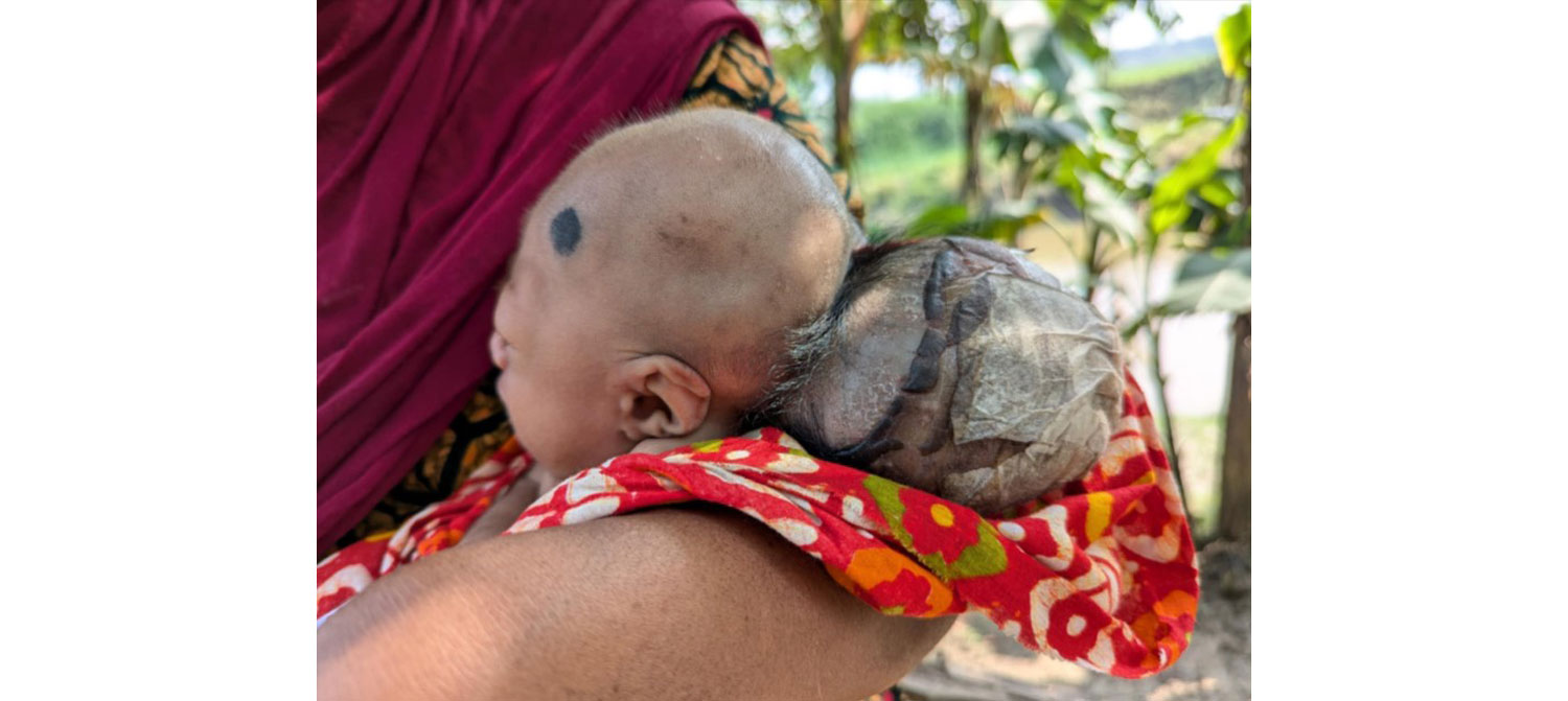 রায়গঞ্জে অর্থের অভাবে চিকিৎসা হচ্ছে না শিশু রিফাতের