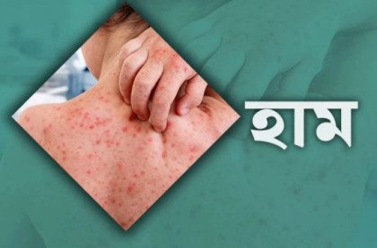 ২৪ ঘণ্টায় হামে আরও ৭ শিশুর মৃত্যু, হাসপাতালে ভর্তি ৭২৯